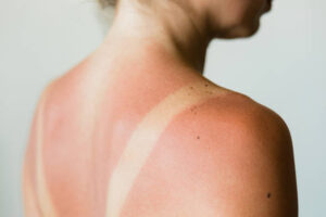 Sol og sommer er lig med solskoldning og solskader på huden